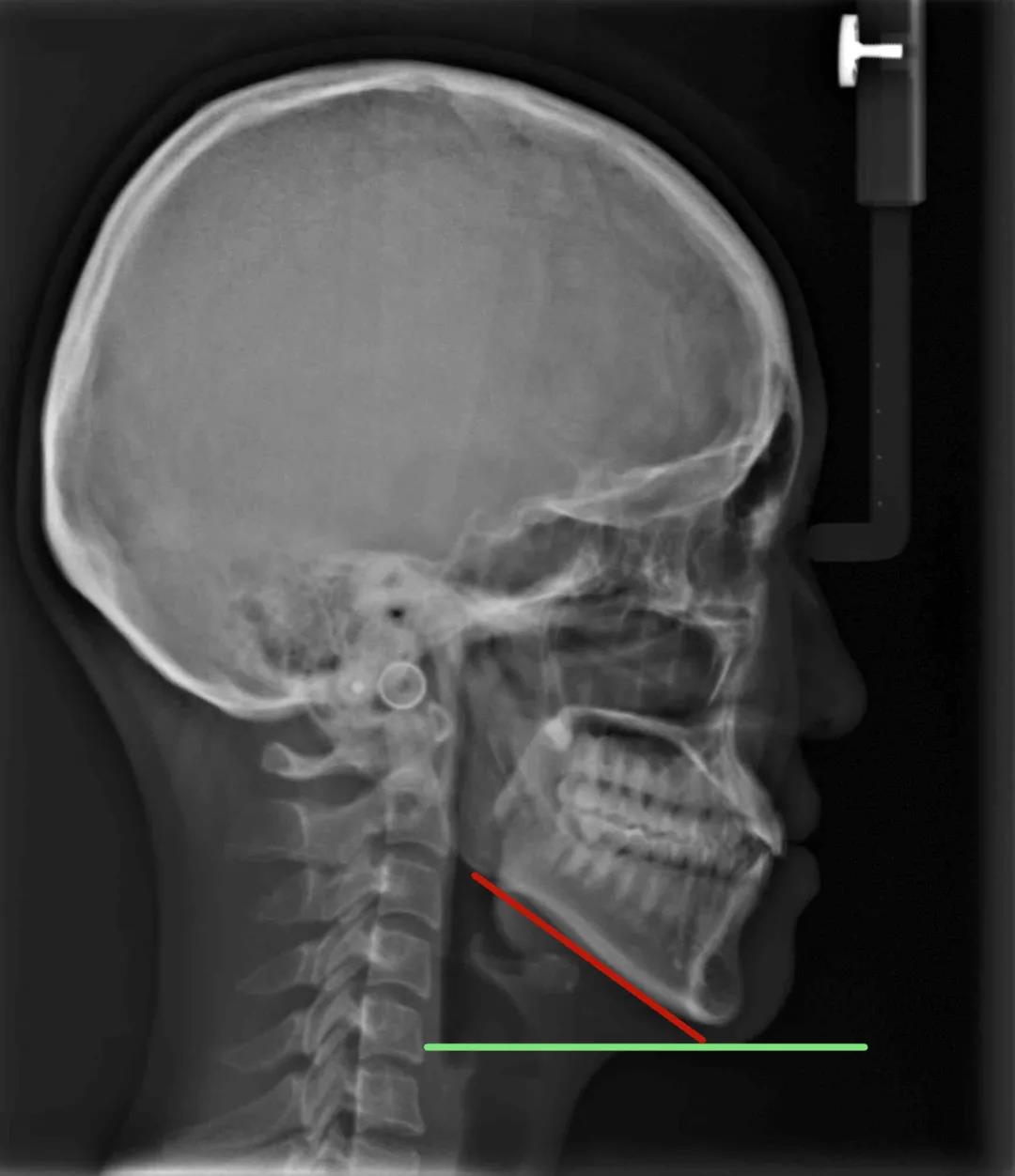 当下颌骨和地面的角度比较大时